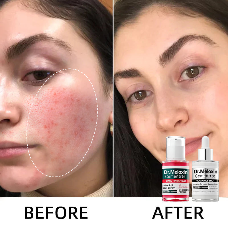 ✨Final 3 Hours: 50% OFF 💥Spot Care Duo | Shrinks Pores & Fades Blemish Marks in 2 Weeks | Cyano Pink Spicule Serum+ Picotonic Shot Ampoule(Two bottles form a set)
